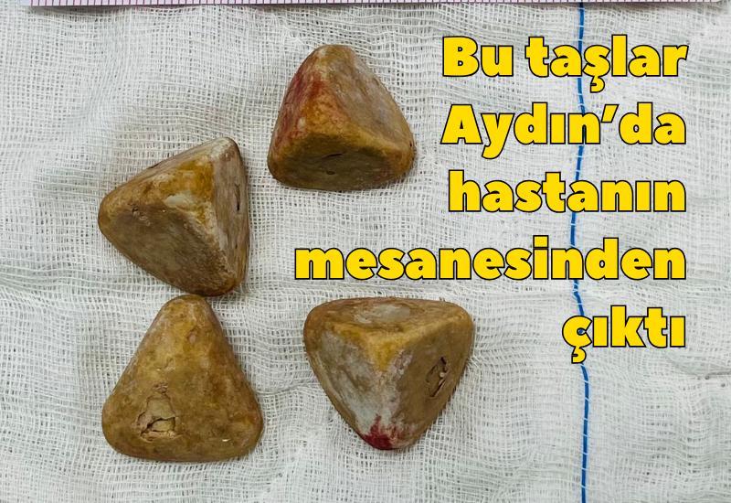 Bu taşlar Aydın'da hastanın mesanesinden çıktı